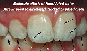 dental-fluorosis.jpg