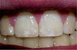 dental-fluorosis2.jpg